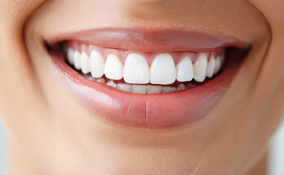 Fairfax Dental Veneers